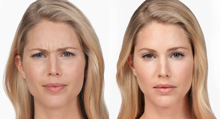 Botox for Forehead Lines The Miracle Shortcut to Look Younger